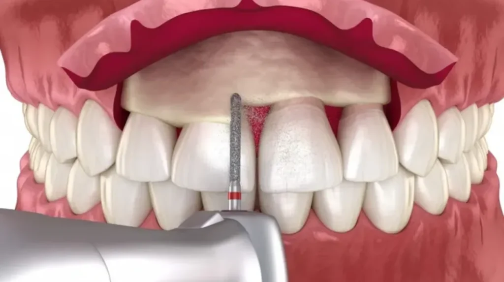 Professional Treatment to treat an infection around a dental implant