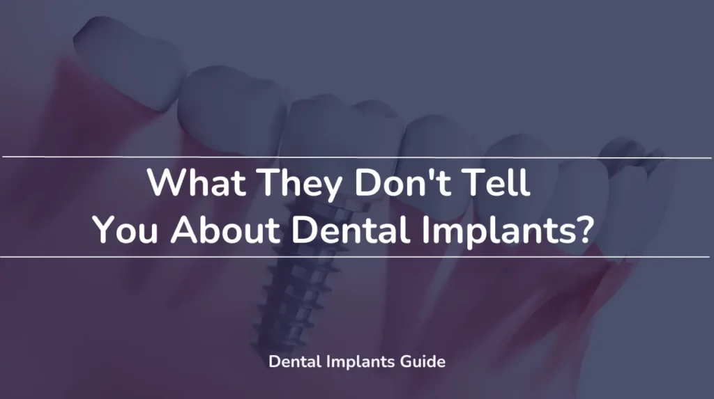 What They Don't Tell You About Dental Implants