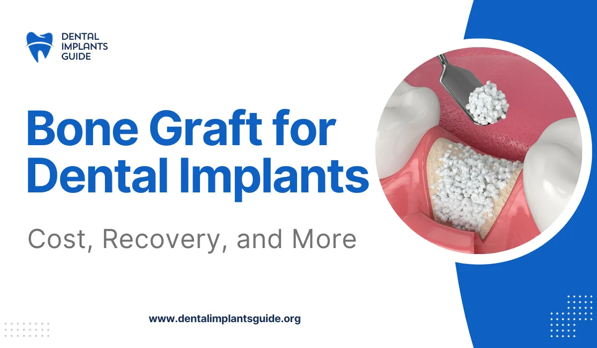 Bone Graft for Dental Implant