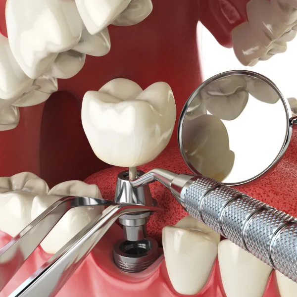 Dental Implants Guide