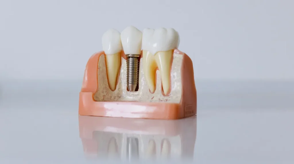How are titanium dental implants placed